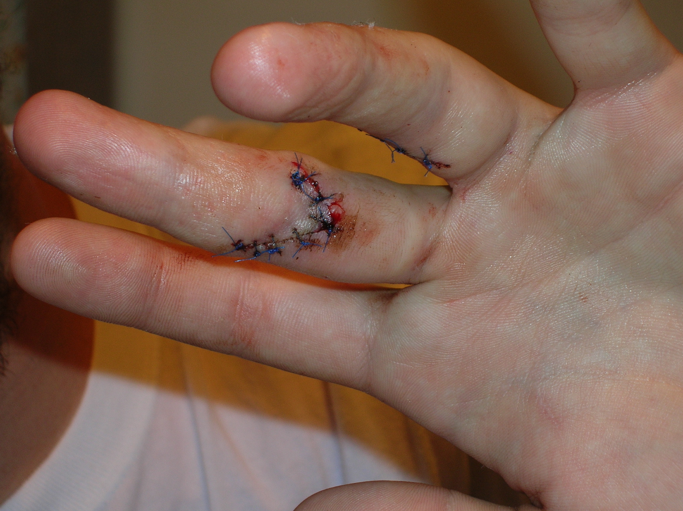 seth wound pictures 016.jpg